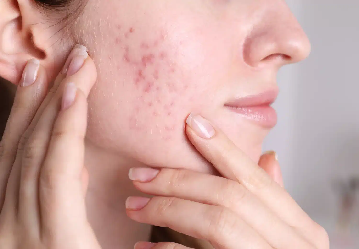 Woman with acne.